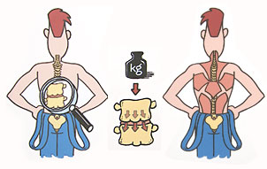 Abbildung mit schematischer Bandscheibe und Rückenmuskulatur